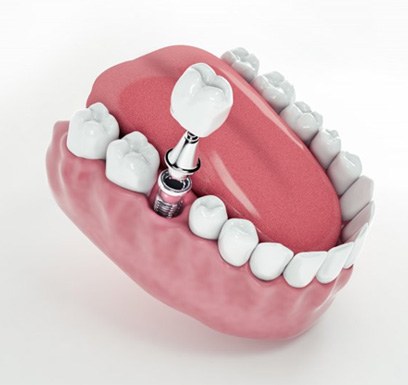 a 3 D illustration of a dental implant among teeth