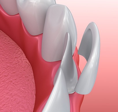 A 3D illustration of a veneer being placed